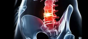 Illustrazione medica della parte inferiore della colonna vertebrale con le vertebre lombari evidenziate in rosso